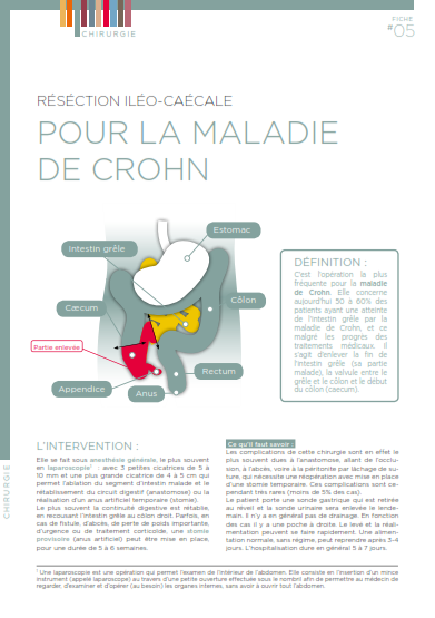 resection ileo caecale